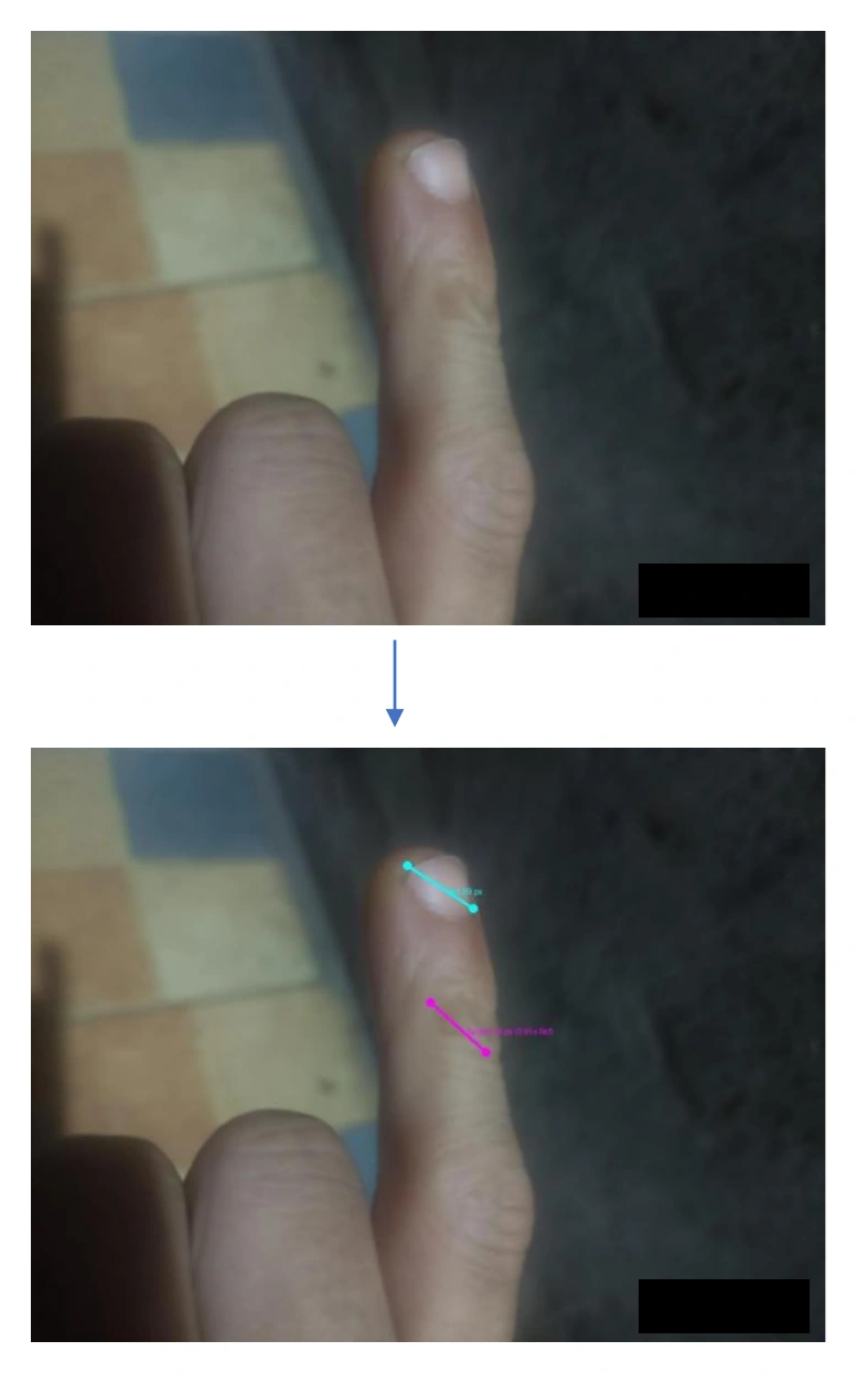 Case 4 comparing the measured long axis of a skin lesion with a fingernail reference