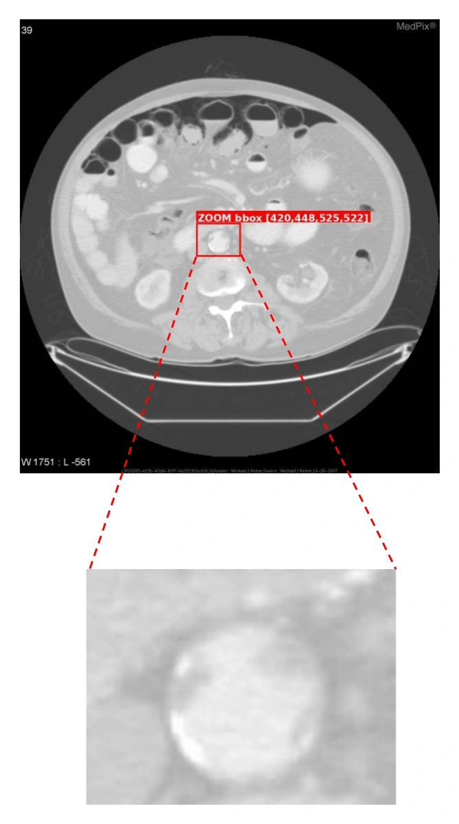 Case 6 showing textual reflection and zoom-based correction for an abdominal aorta finding