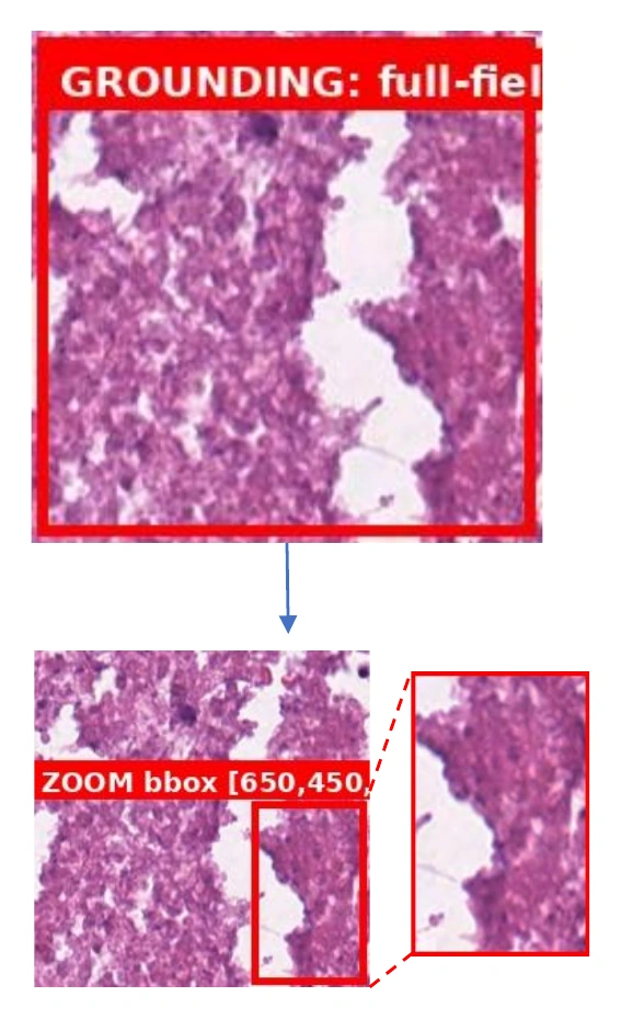 Example of MIRA inspecting a medical image, recognizing insufficient evidence, and zooming to verify the finding